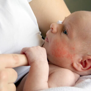 Prevent these infant skin issues to keep your baby’s skin flawless